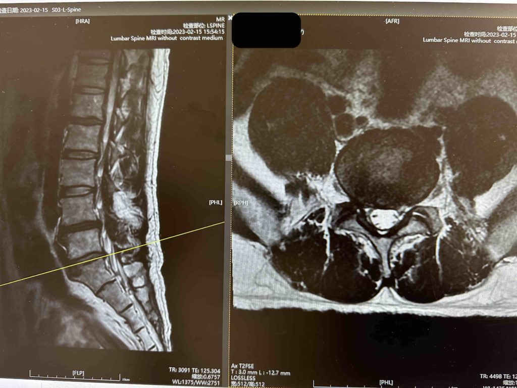 Wow my lower back MRI!