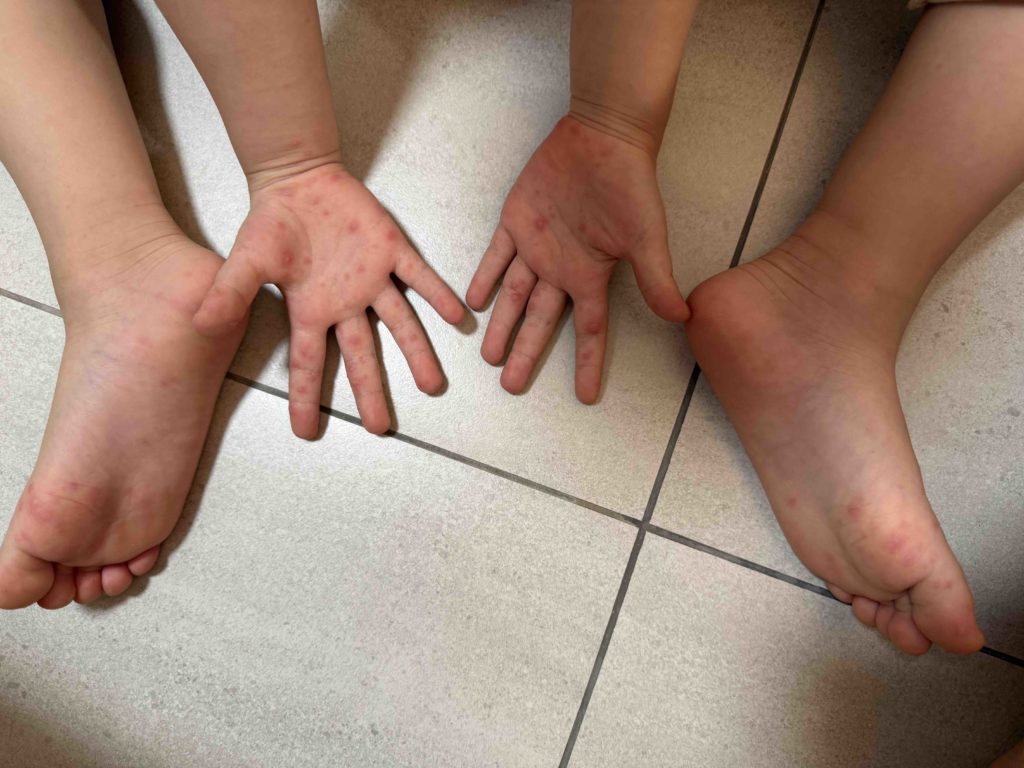 HFMD getting worse...