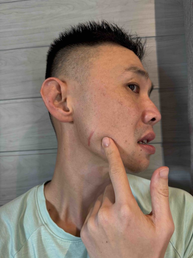 Got kicked and scratched by a fellow (female) participant by her toenail.