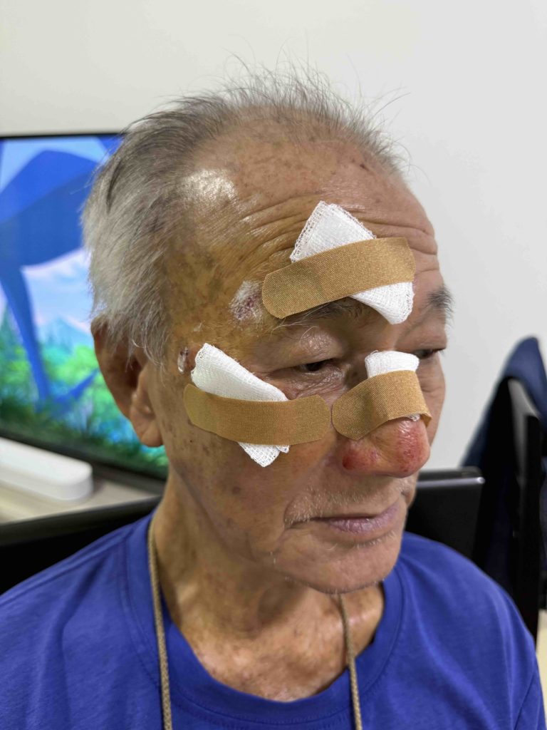 Clean and dressed the wound with antibacterial cream. Thankfully the swelling went down.