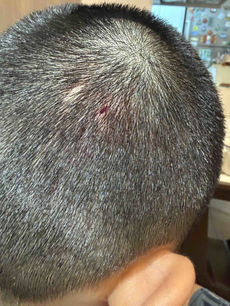 Much clearer where is the wound after stopping the bleed.