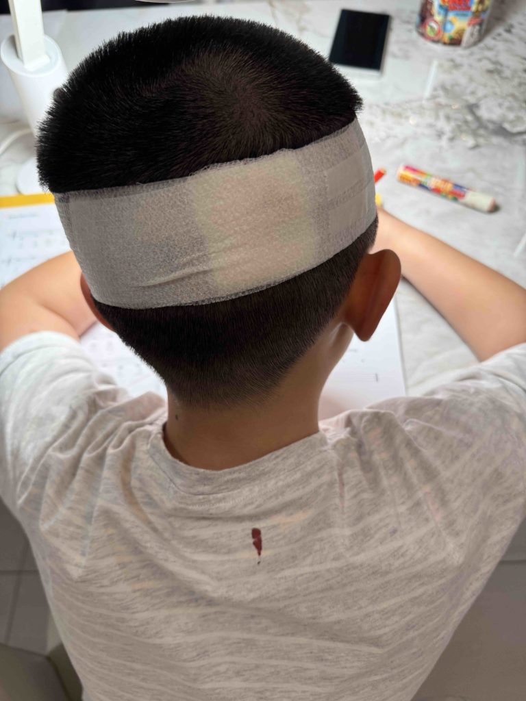 Bandaged up to keep pressure on the wound.