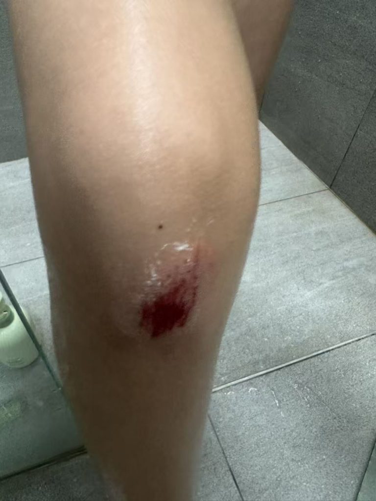 Falling down and scrapping his knee...