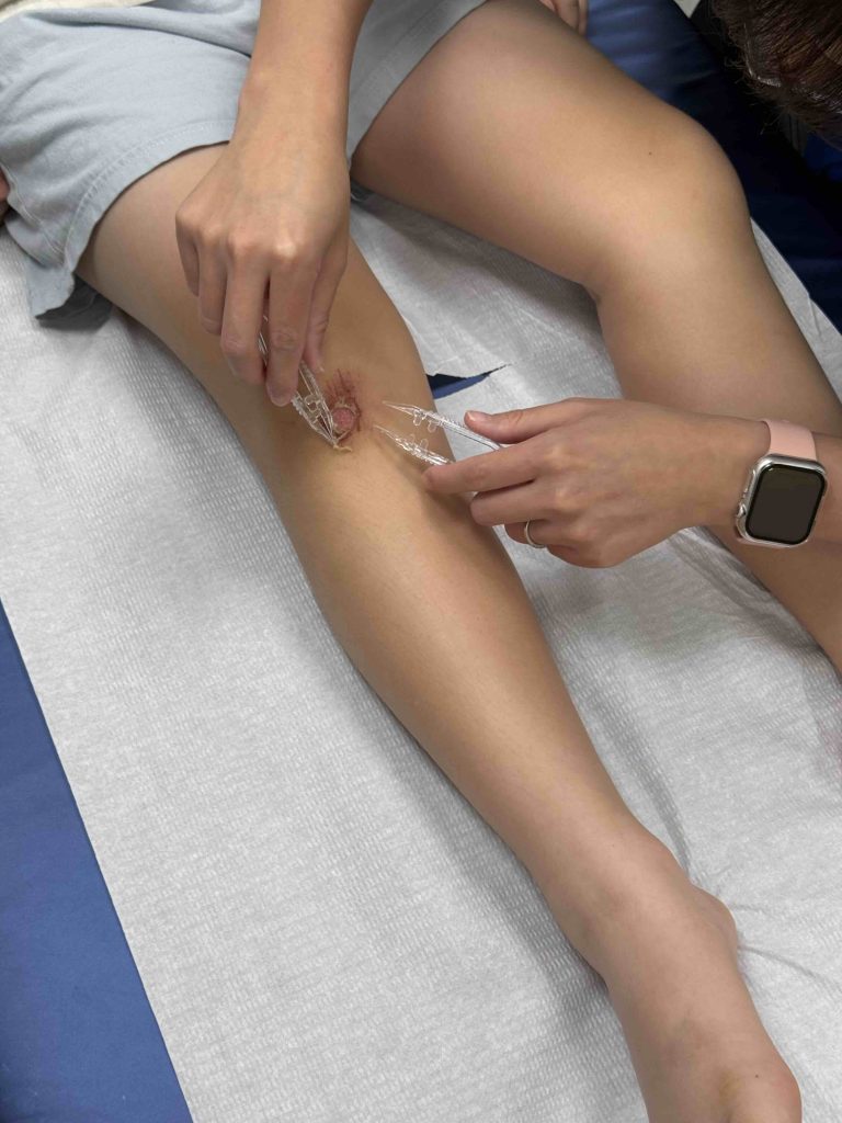 Enjoying 5 Star wound care treatment...